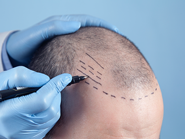 Discover the Enchanting Results of Sapphire FUE Hair Transplantation